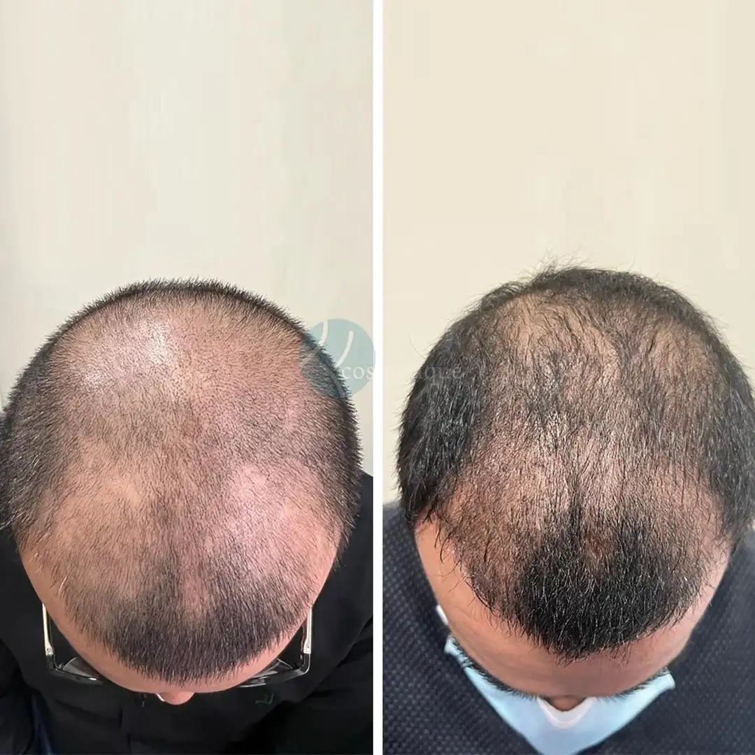 PRP follicle strengthening treatment before and after images