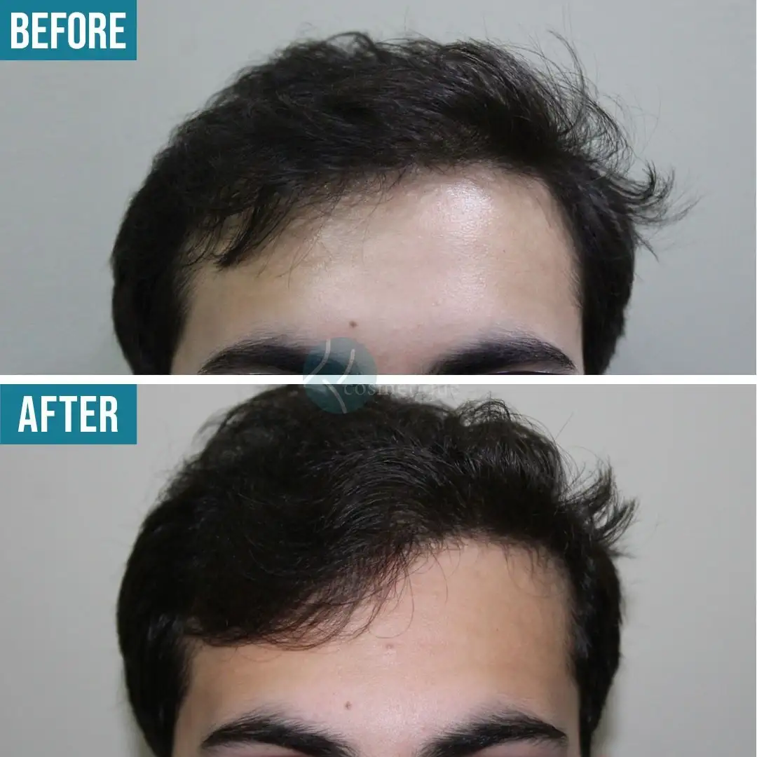 PRP hair density enhancement treatment before and after