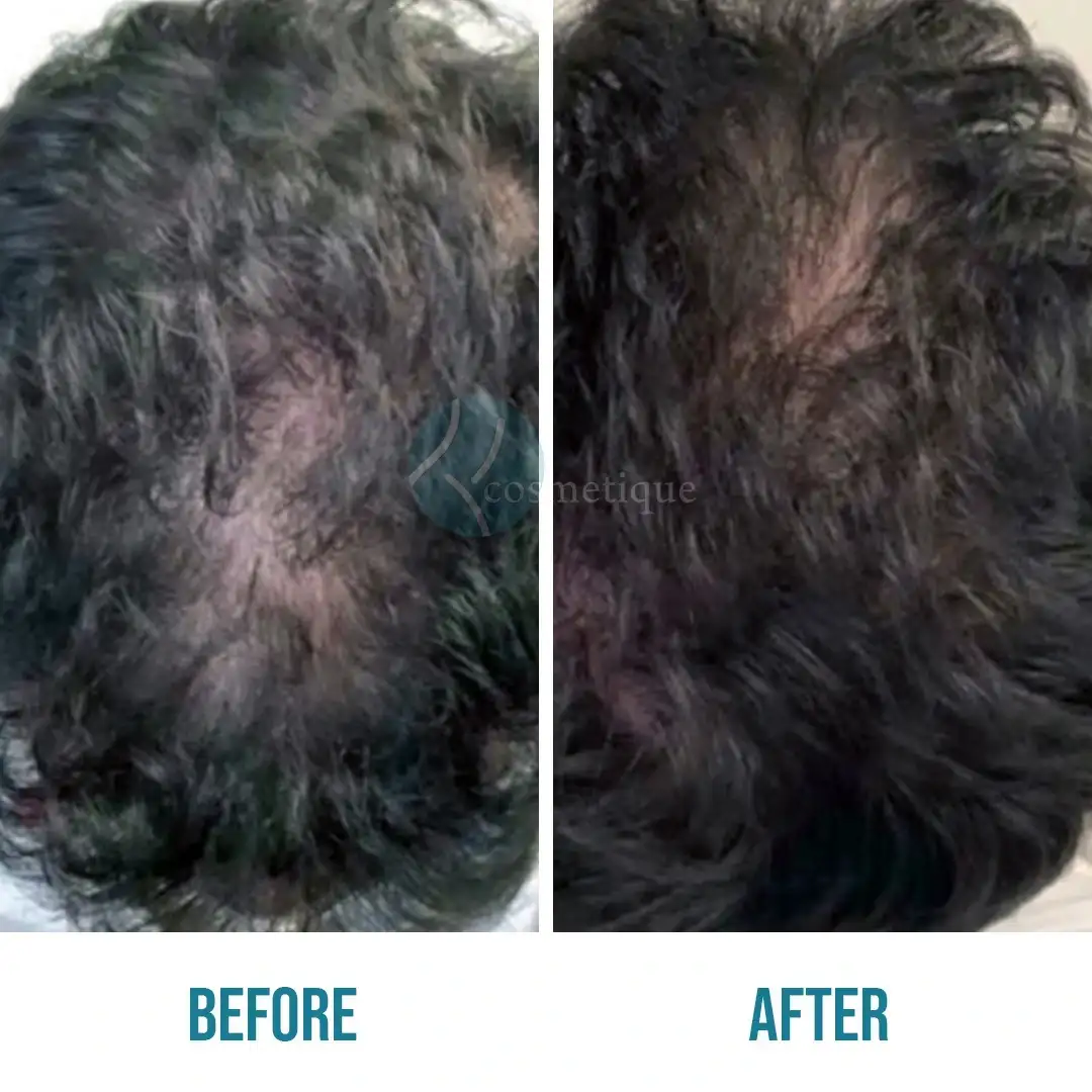 PRP hair growth treatment results before and after