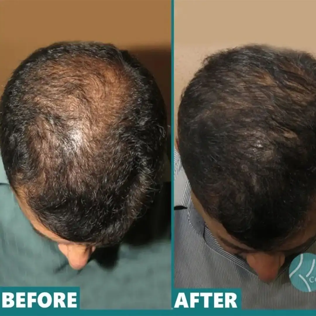 PRP hair restoration treatment before and after results