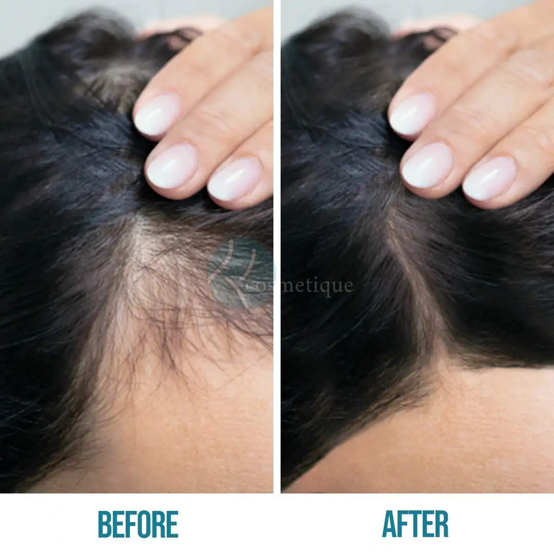PRP regenerative hair treatment before and after results