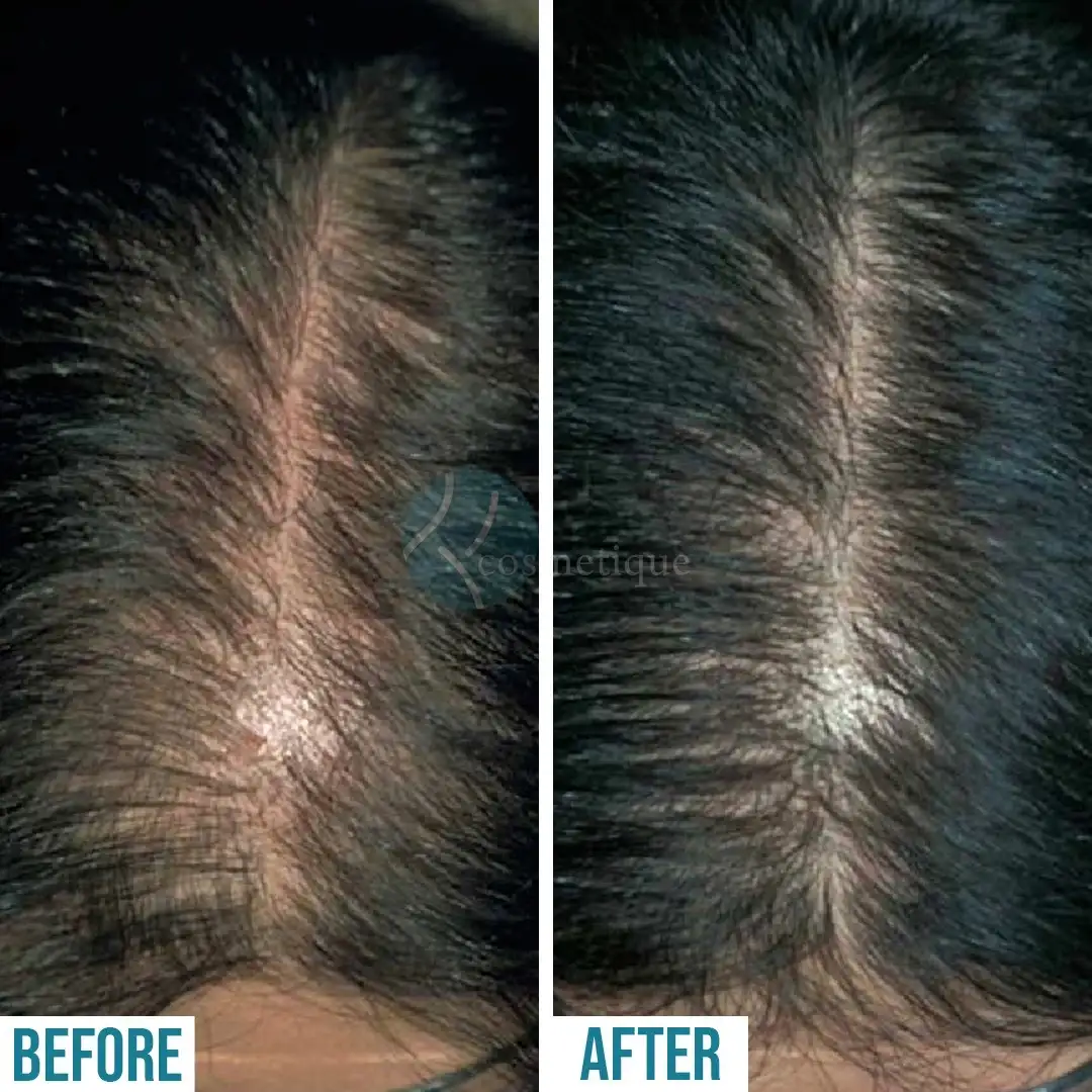 PRP scalp treatment progress before and after images