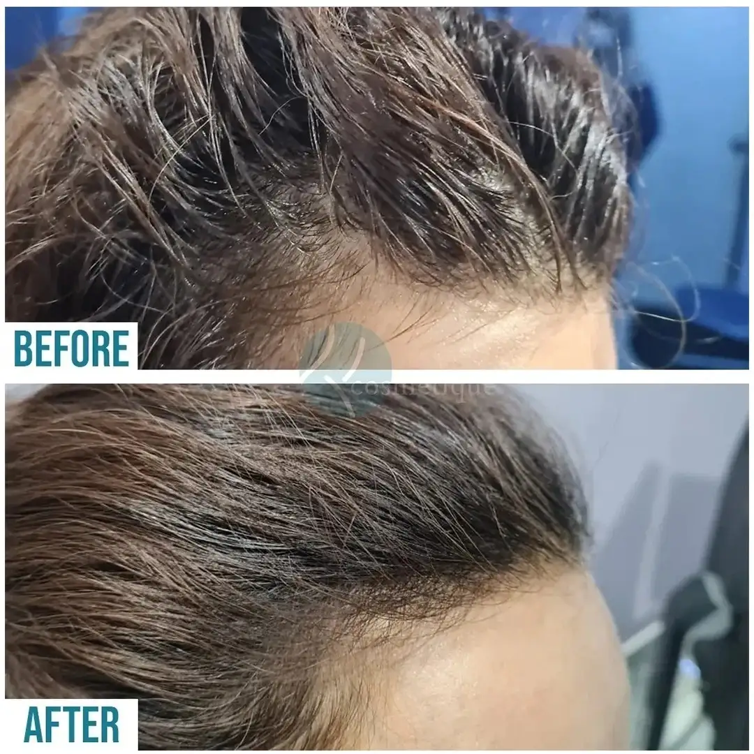 PRP thinning hair improvement before and after treatment