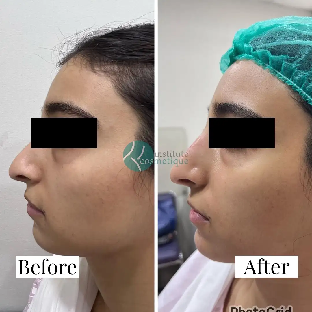 Rhinoplasty aesthetic improvement before and after results