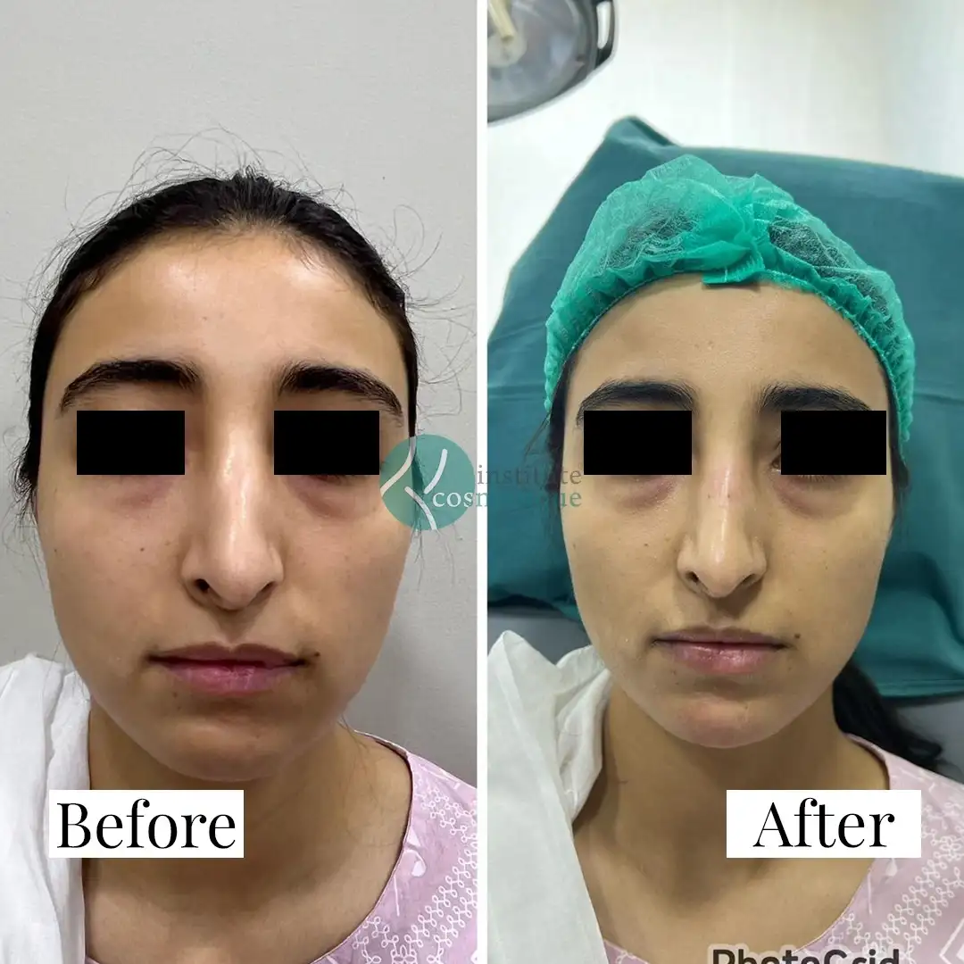 Rhinoplasty facial balance improvement before and after treatment