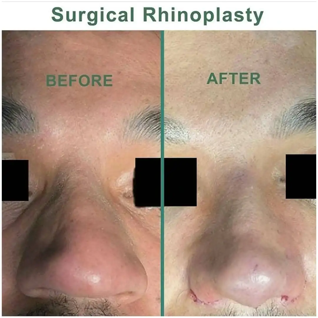 Rhinoplasty nasal enhancement surgery before and after images
