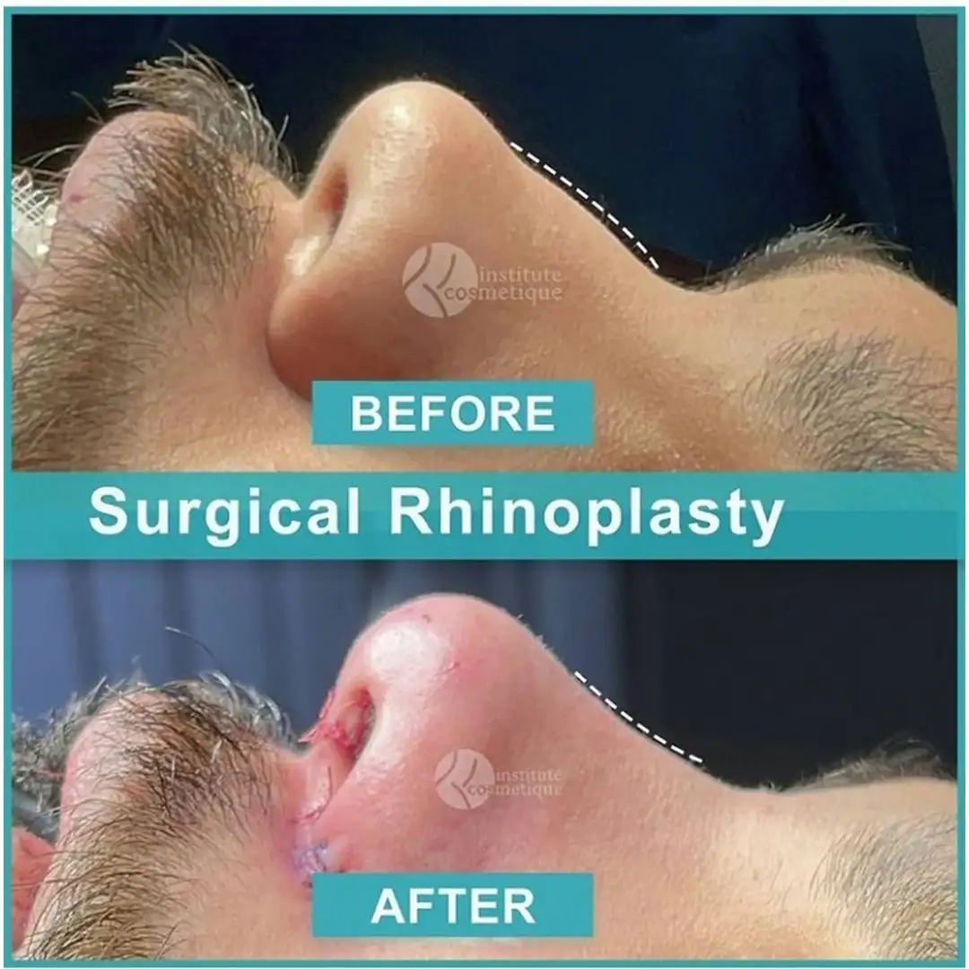 Rhinoplasty nose refinement before and after results