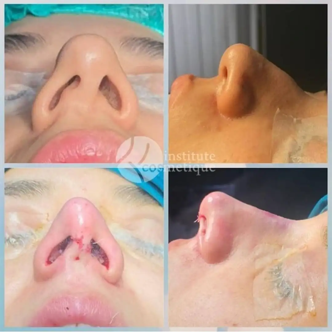 Rhinoplasty nose shape correction before and after results