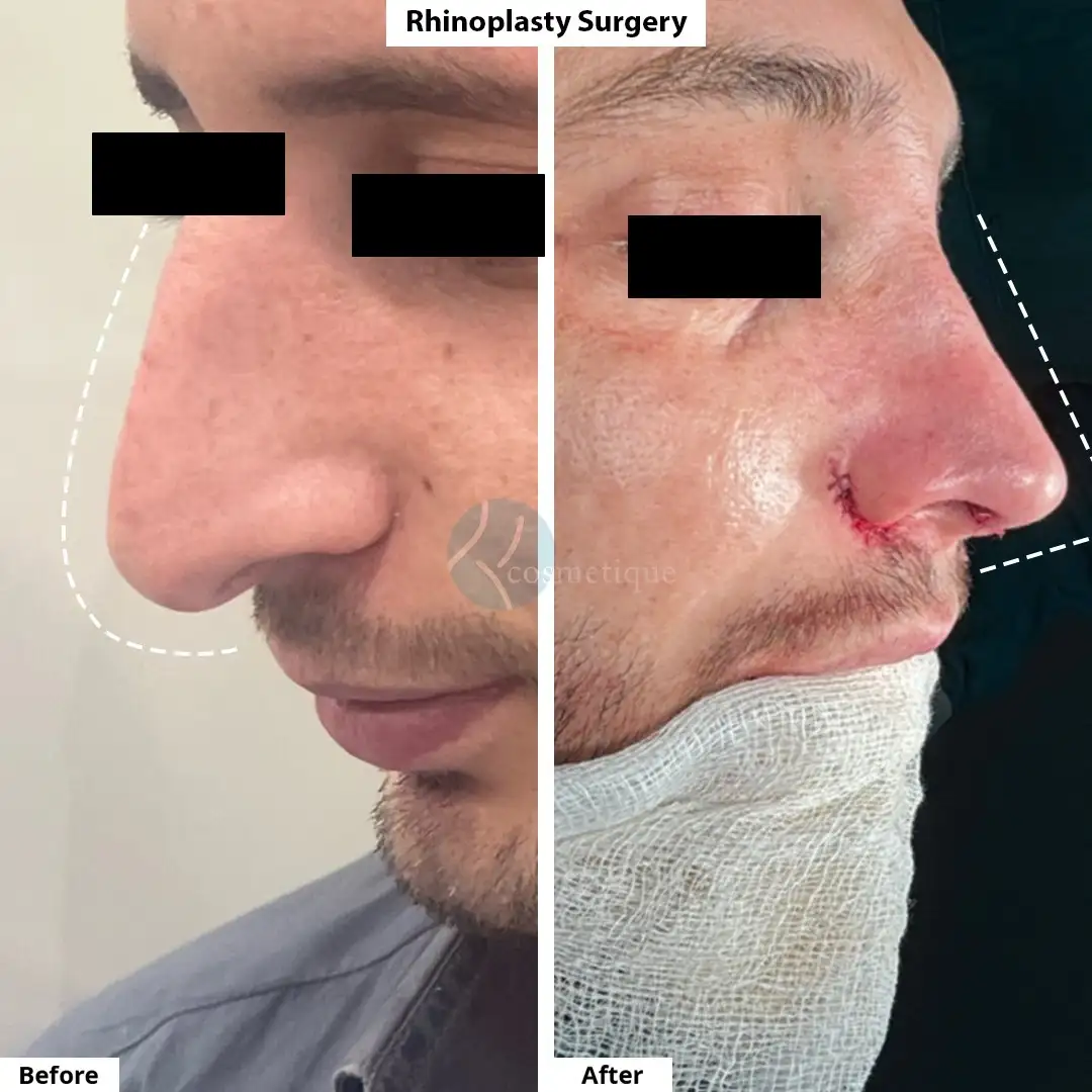 Rhinoplasty profile correction before and after images