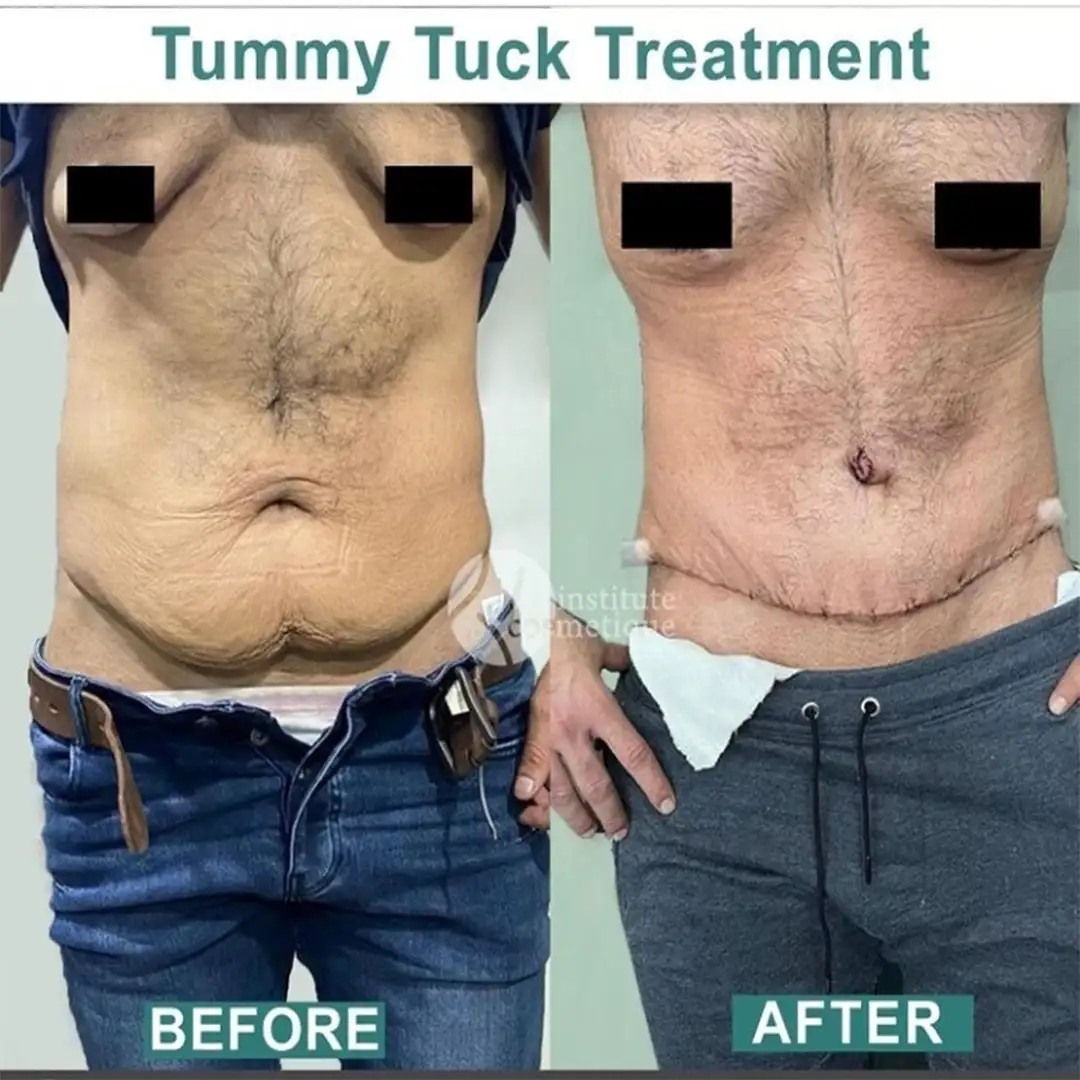 Tummy tuck abdominoplasty before and after results
