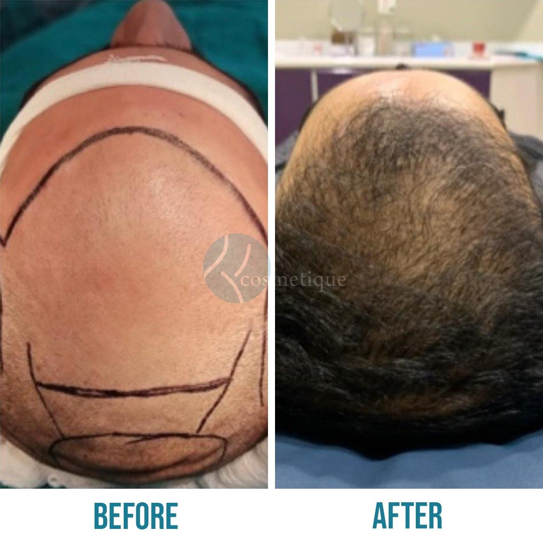 Best hair transplant in Pakistan - Before and after transformation displaying significant hair growth post-hair transplant.