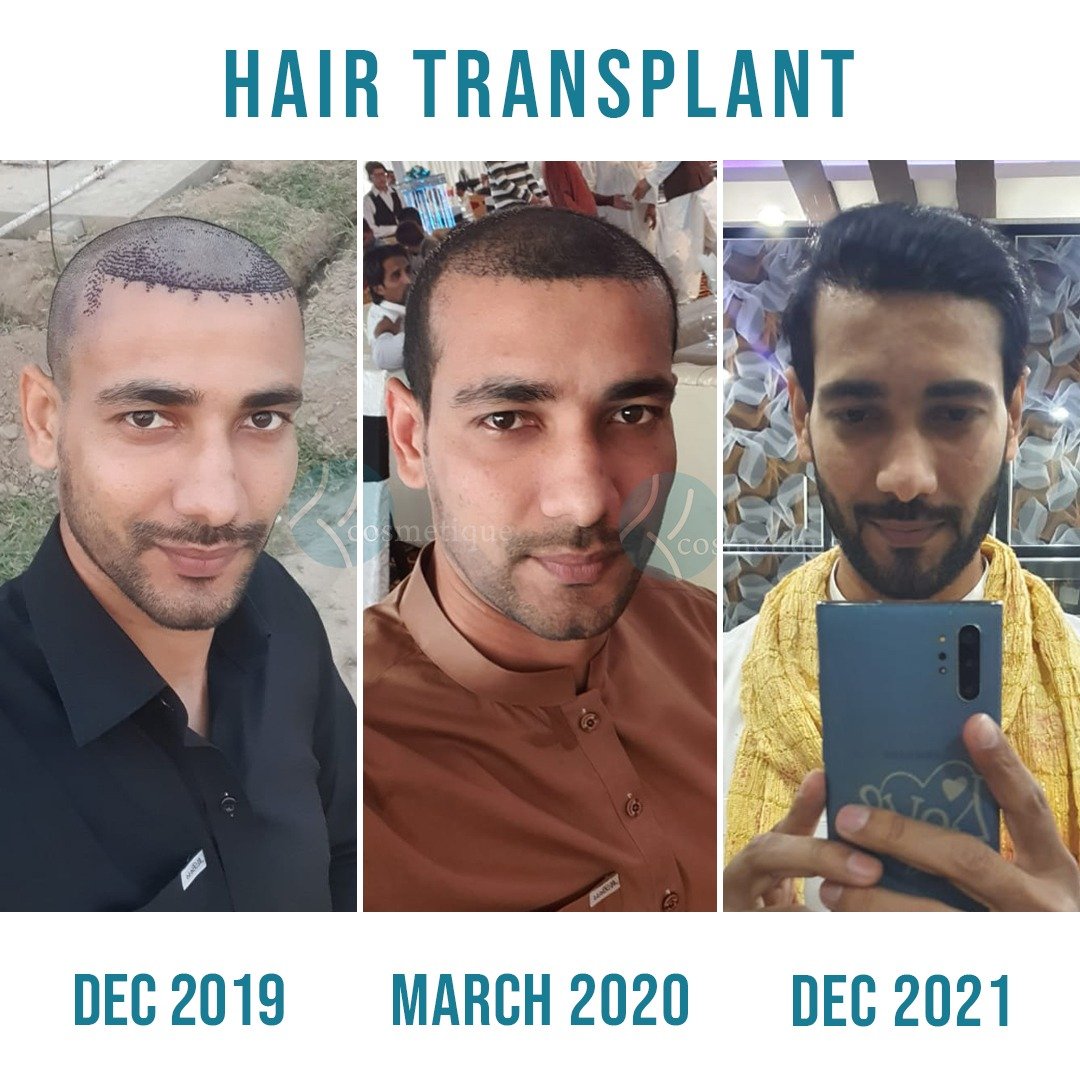 Progress photos of male hair transplant results from Dec 2019 to Dec 2021 – best hair transplant in Pakistan.