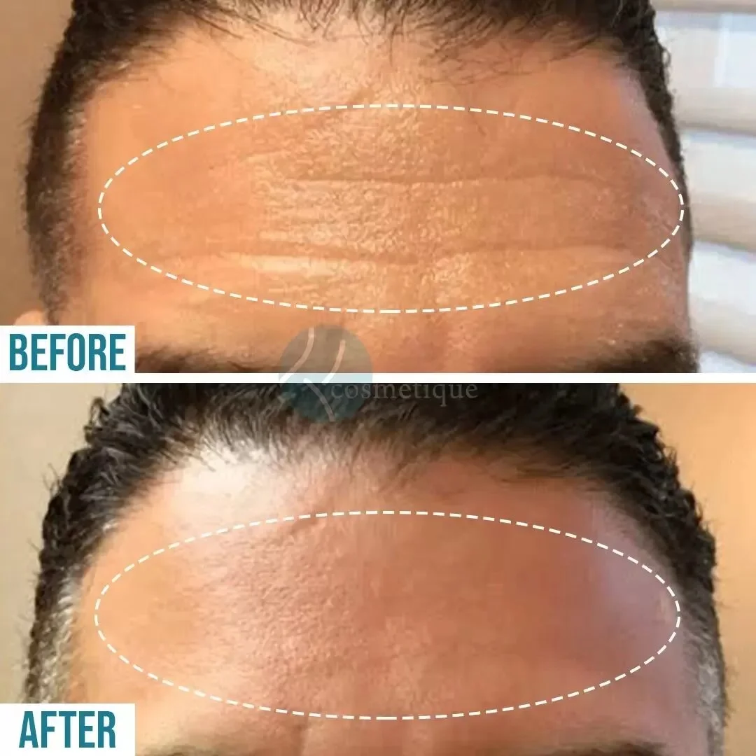 Forehead Botox before and after results - smooth skin, Institute Cosmetique.