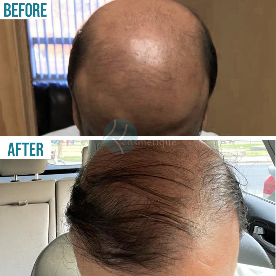 cosmetique hair transplant before after