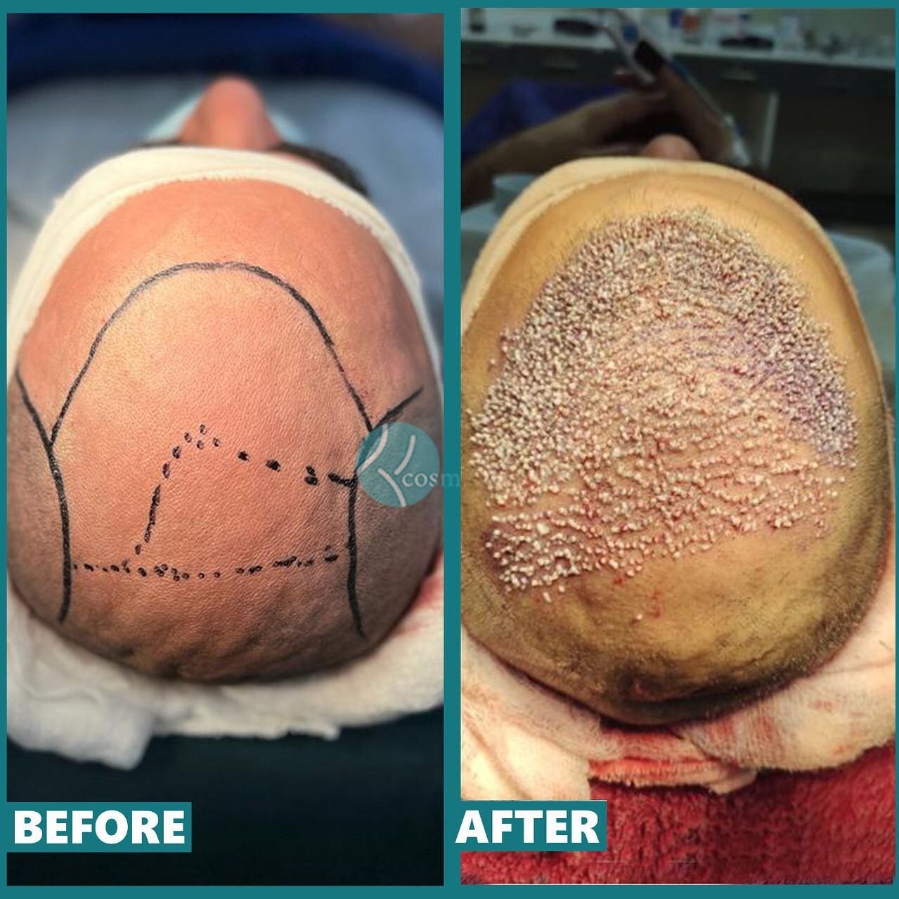 Best hair transplant in Pakistan - Before and after results showing hair transplant planning and initial graft placement.