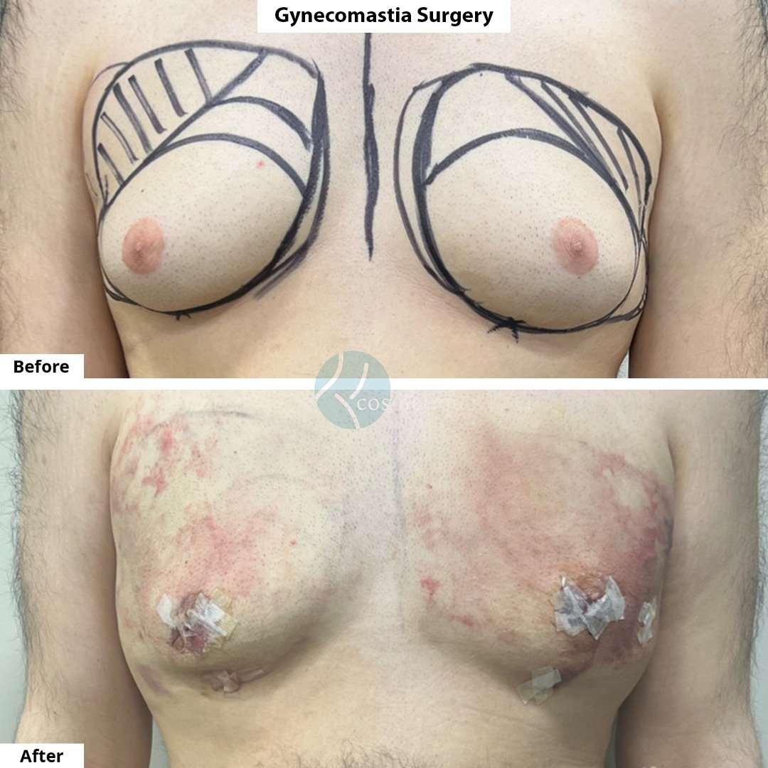 Gynecomastia Before After