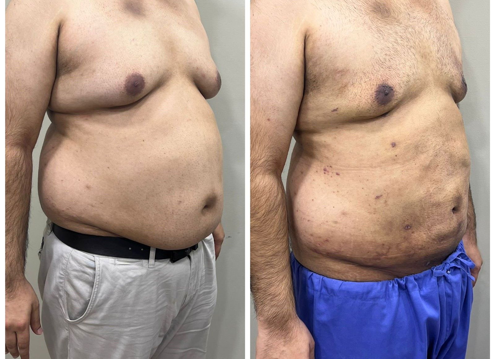 Gynecomastia Before After
