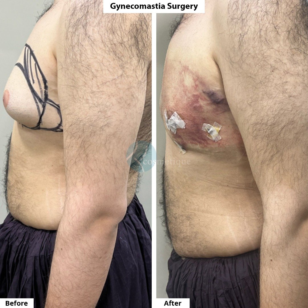 Gynecomastia Before After