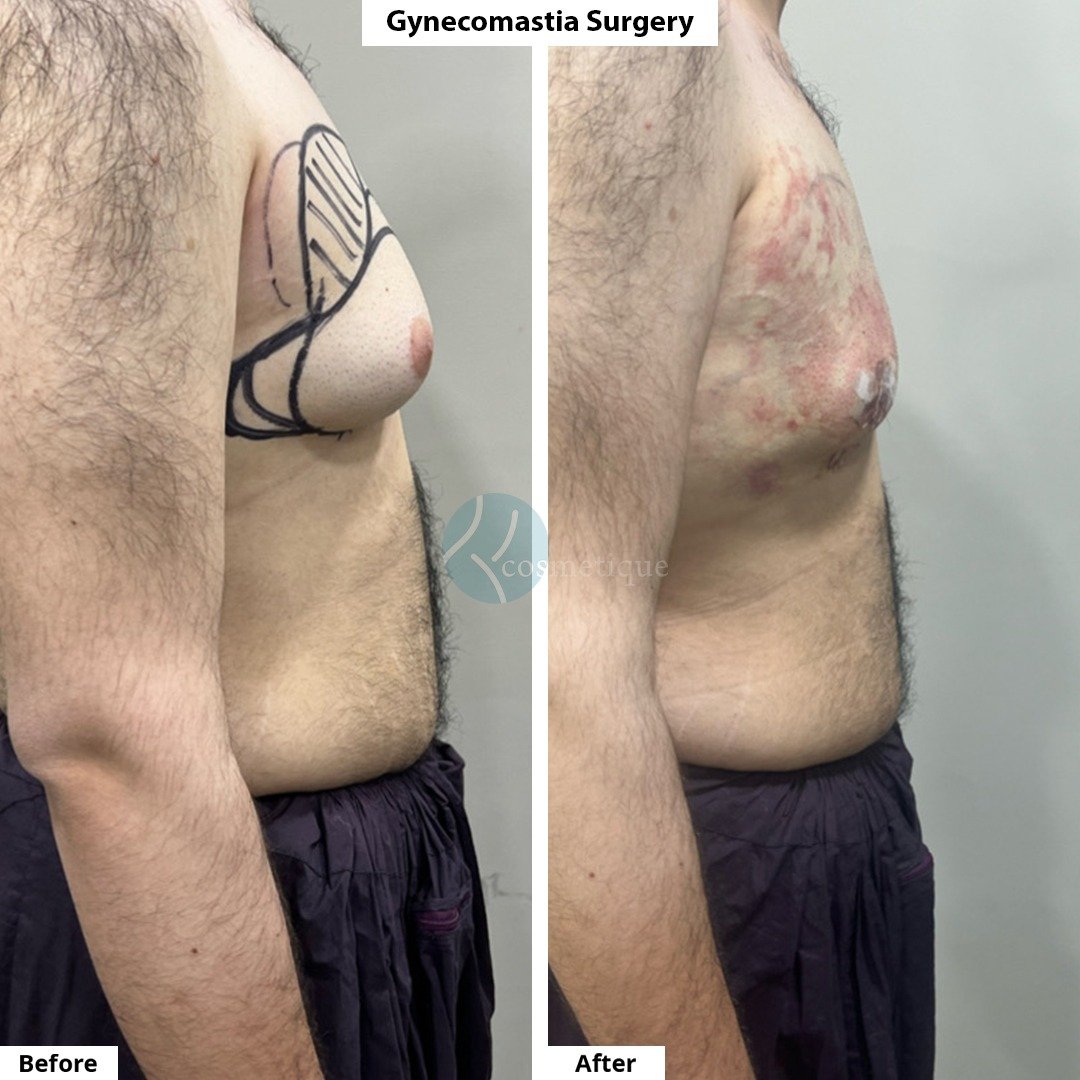 Gynecomastia Before After