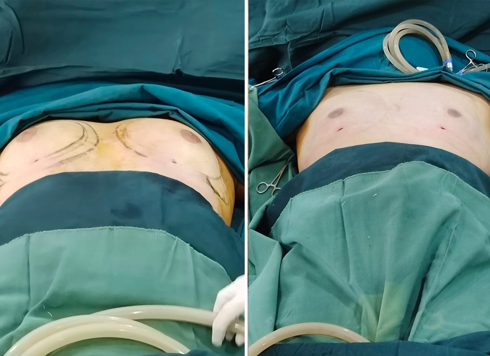 Gynecomastia Before After