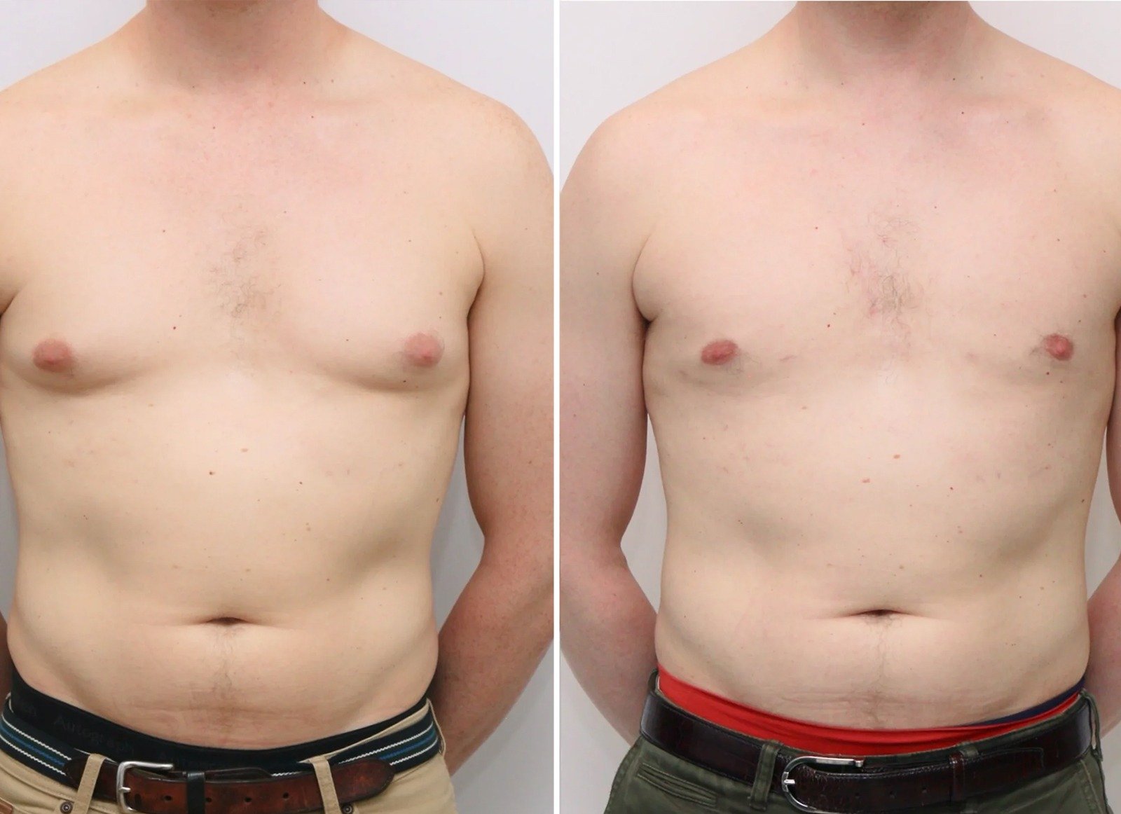 Gynecomastia Before After