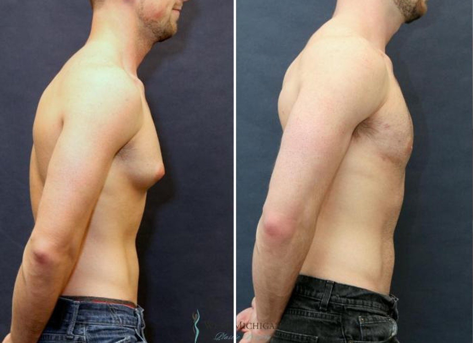 Gynecomastia Before After