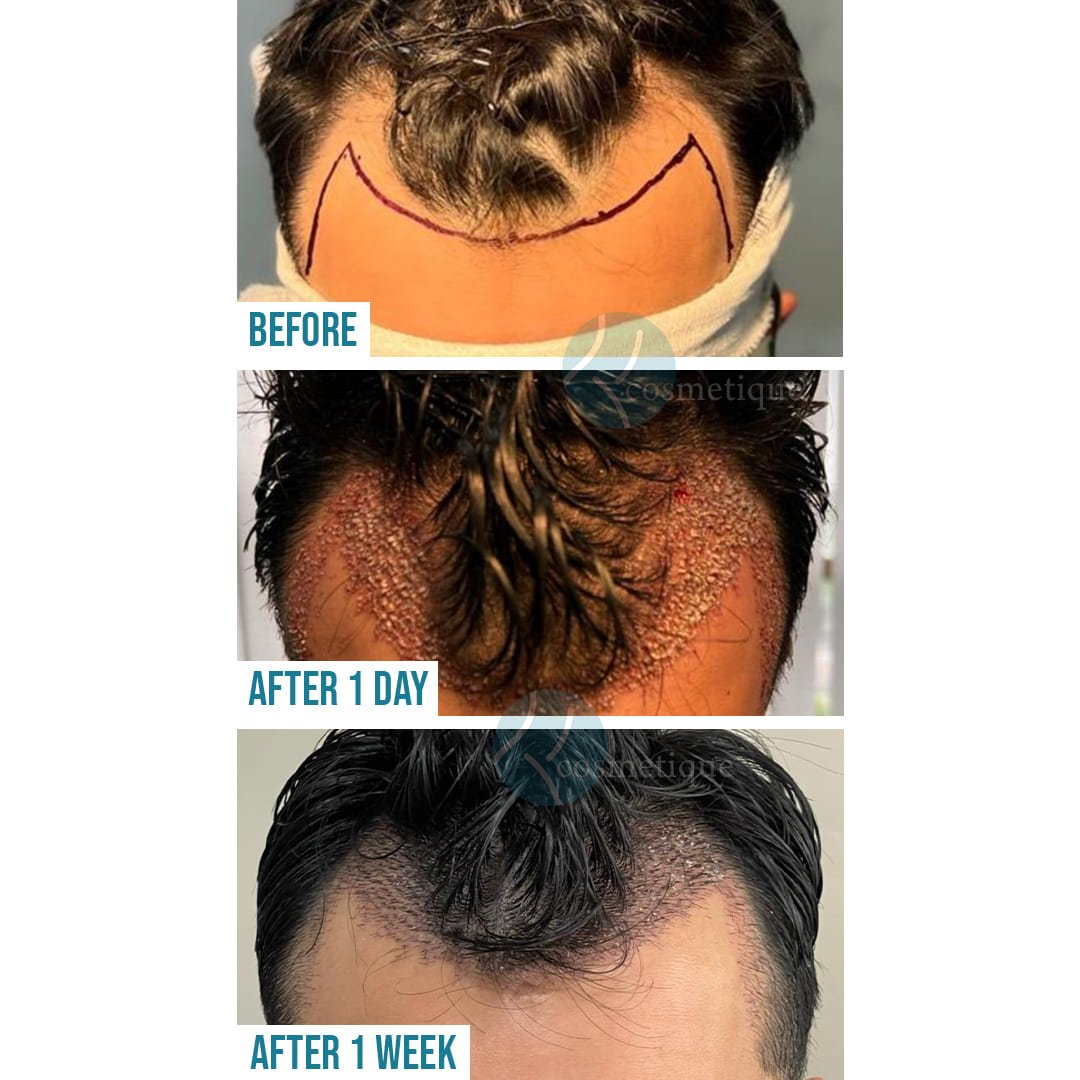 Before the procedure, hairline marking is visible. After one day, scalp healing with visible grafts is shown. After one week, hair growth and improved scalp condition are noticeable.