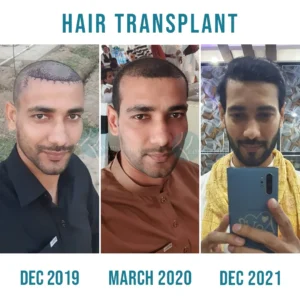 best-real-time-hair-transplant