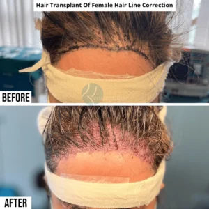 hair-transplant-before-after-female-hiar-line