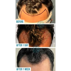hair-transplant-before-after-pic