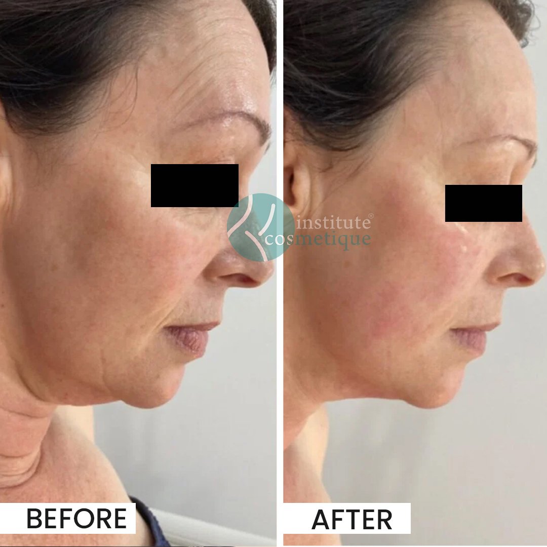 Advanced HIFU therapy for youthful skin at Institute Cosmetique