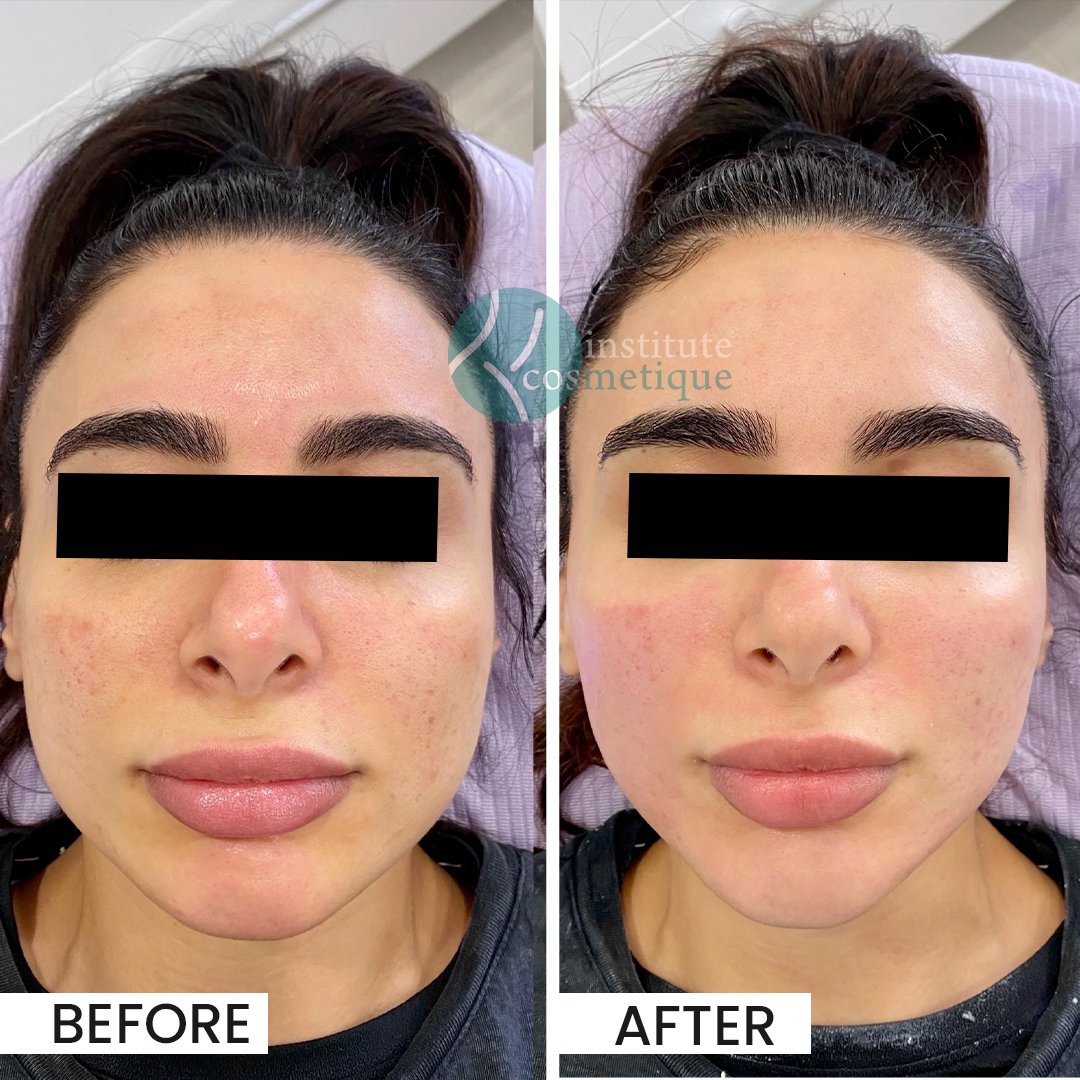 HIFU procedure targeting wrinkles and fine lines at Institute Cosmetique