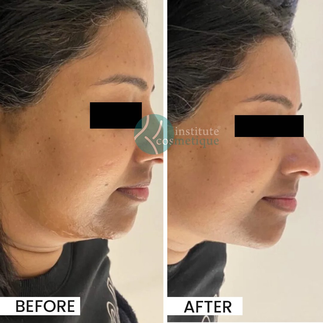 Client experiencing painless HIFU facial rejuvenation at Institute Cosmetique